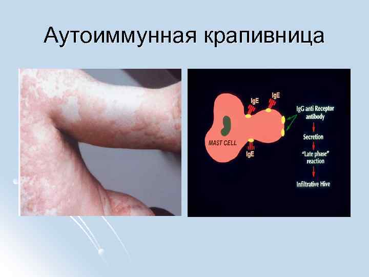 Аутоиммунная крапивница 