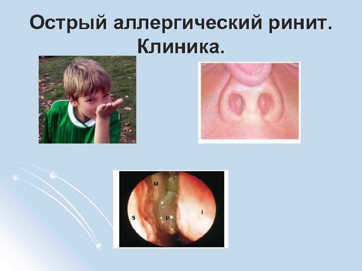 Острый аллергический ринит. Клиника. 