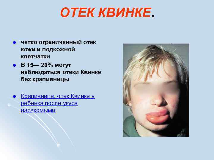 ОТЕК КВИНКЕ. l l l четко ограниченный отек кожи и подкожной клетчатки В 15—