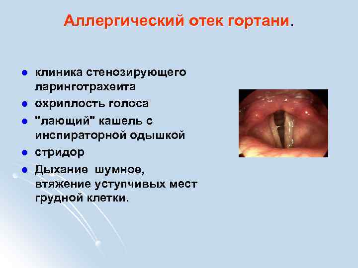 Аллергический отек гортани. l l l клиника стенозирующего ларинготрахеита охриплость голоса "лающий" кашель с
