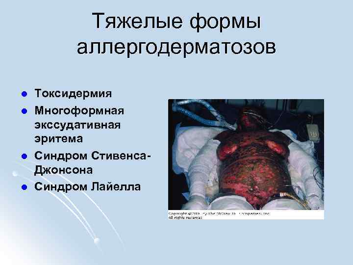 Тяжелые формы аллергодерматозов l l Токсидермия Многоформная экссудативная эритема Синдром Стивенса. Джонсона Синдром Лайелла