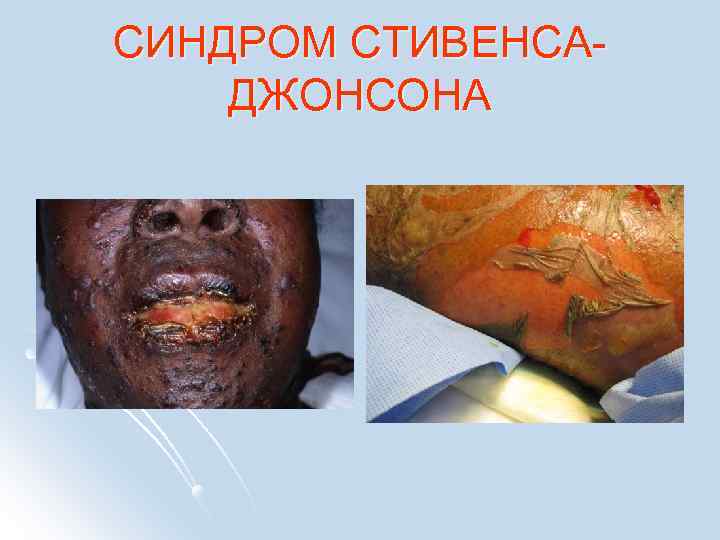 СИНДРОМ СТИВЕНСАДЖОНСОНА 