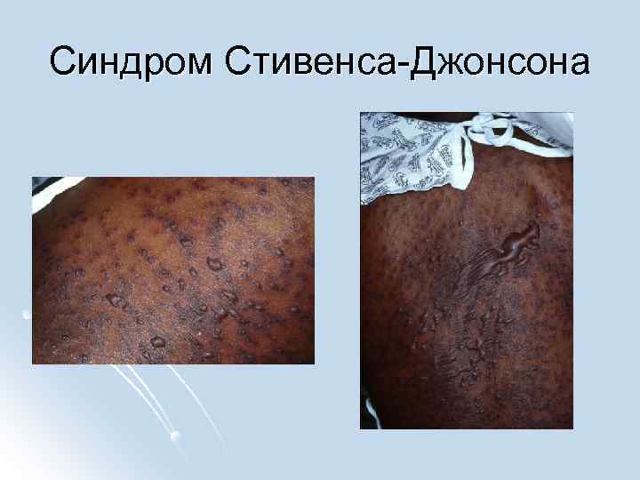 Синдром Стивенса-Джонсона 