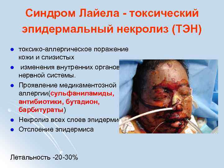 Синдром Лайела - токсический эпидермальный некролиз (ТЭН) l l l токсико-аллергическое поражение кожи и