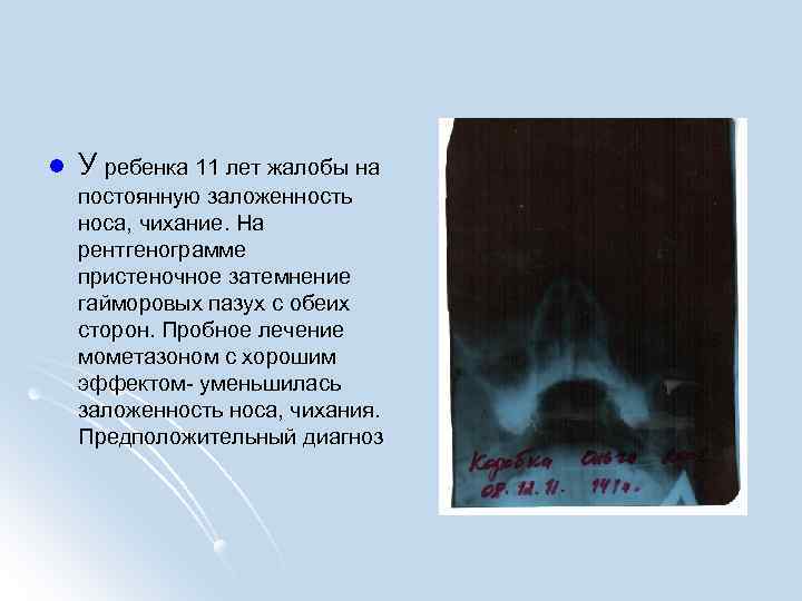 l У ребенка 11 лет жалобы на постоянную заложенность носа, чихание. На рентгенограмме пристеночное