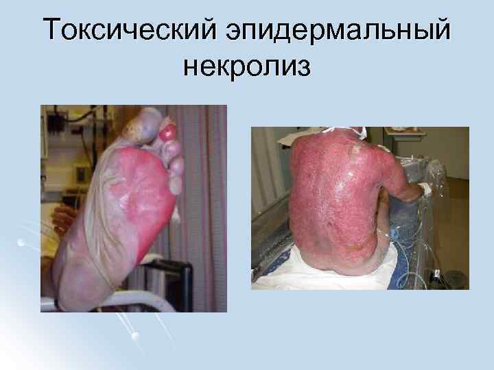 Токсический эпидермальный некролиз 