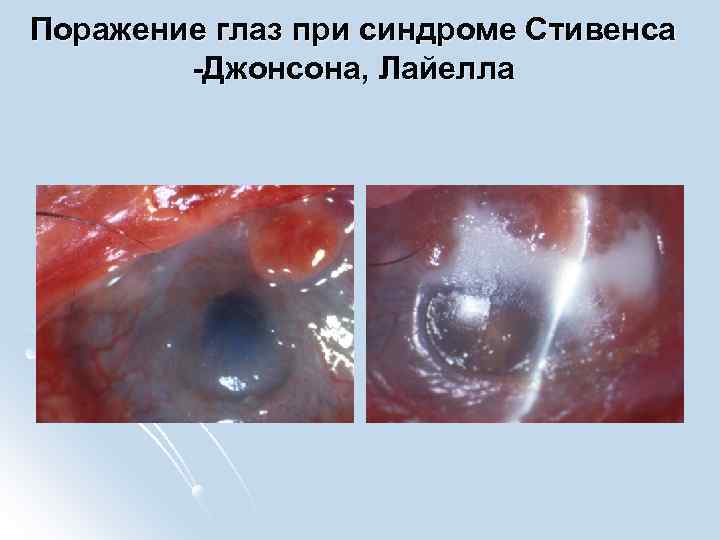 Поражение глаз при синдроме Стивенса -Джонсона, Лайелла 