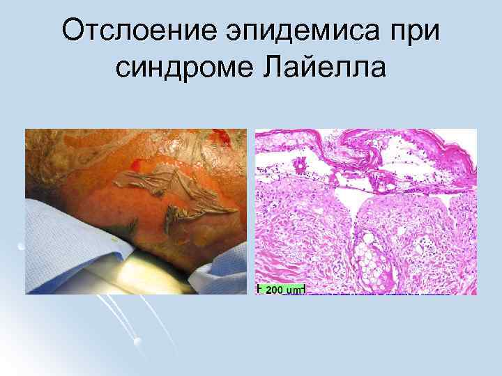 Отслоение эпидемиса при синдроме Лайелла 