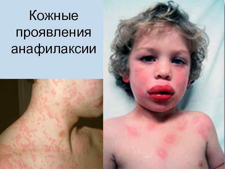 Кожные проявления анафилаксии 