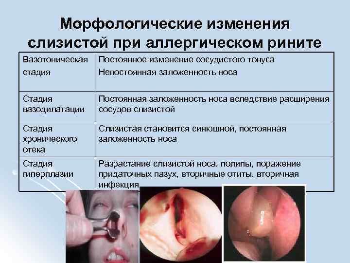 Морфологические изменения слизистой при аллергическом рините Вазотоническая стадия Постоянное изменение сосудистого тонуса Непостоянная заложенность