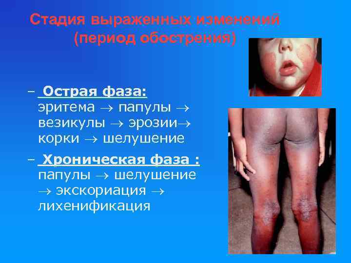 Стадия выраженных изменений (период обострения) – Острая фаза: эритема папулы везикулы эрозии корки шелушение