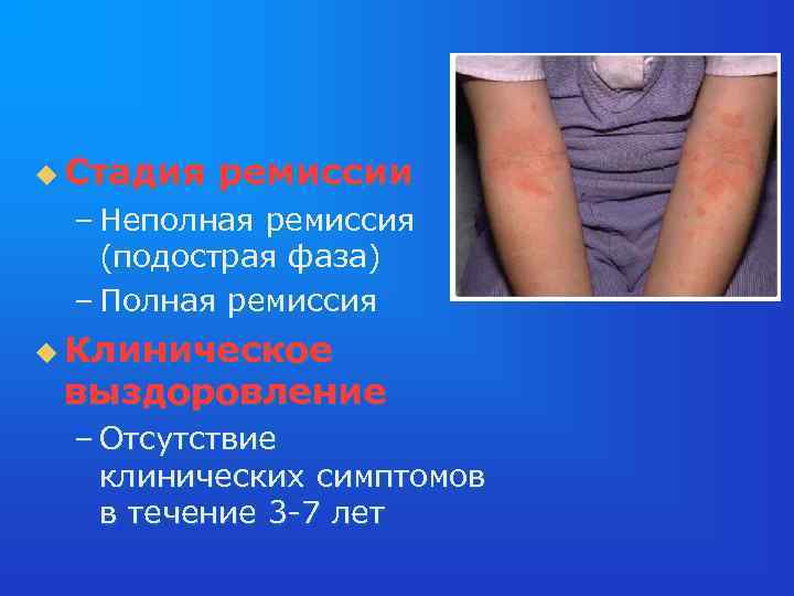 u Стадия ремиссии – Неполная ремиссия (подострая фаза) – Полная ремиссия u Клиническое выздоровление