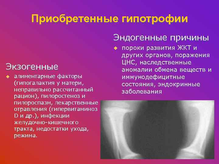 Приобретенные гипотрофии Эндогенные причины u Экзогенные u алиментарные факторы (гипогалактия у матери, неправильно рассчитанный