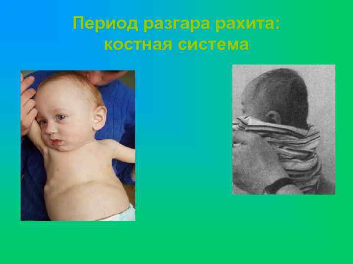 Период разгара рахита: костная система 