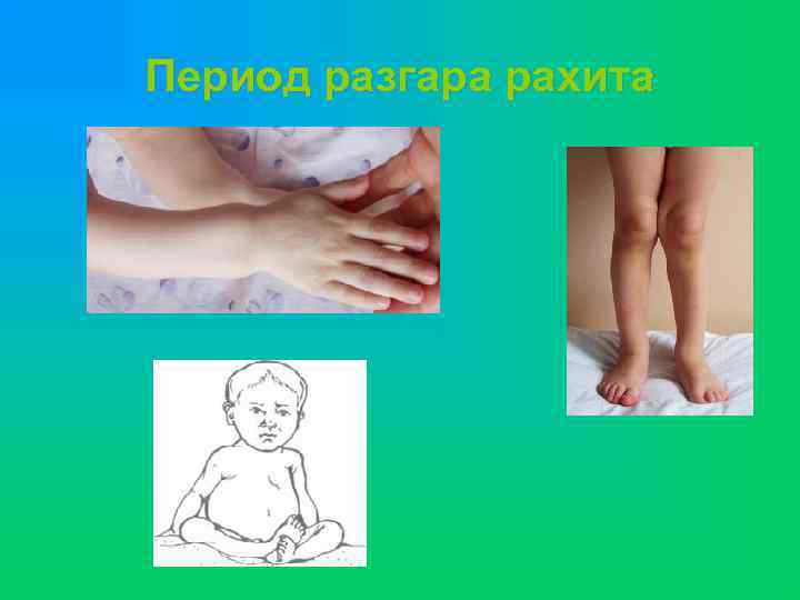 Период разгара рахита 