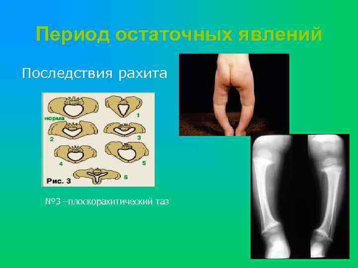 Период остаточных явлений Последствия рахита № 3 –плоскорахитический таз 