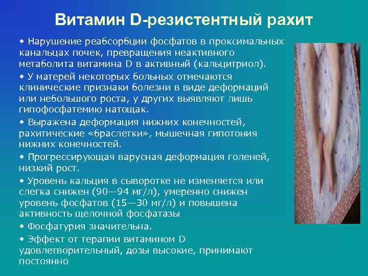 Витамин D-резистентный рахит • Нарушение реабсорбции фосфатов в проксимальных канальцах почек, превращения неактивного метаболита