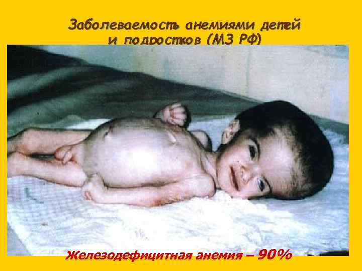 Заболеваемость анемиями детей и подростков (МЗ РФ) Железодефицитная анемия – 90% 