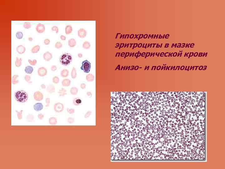 Гипохромные эритроциты в мазке периферической крови Анизо- и пойкилоцитоз 