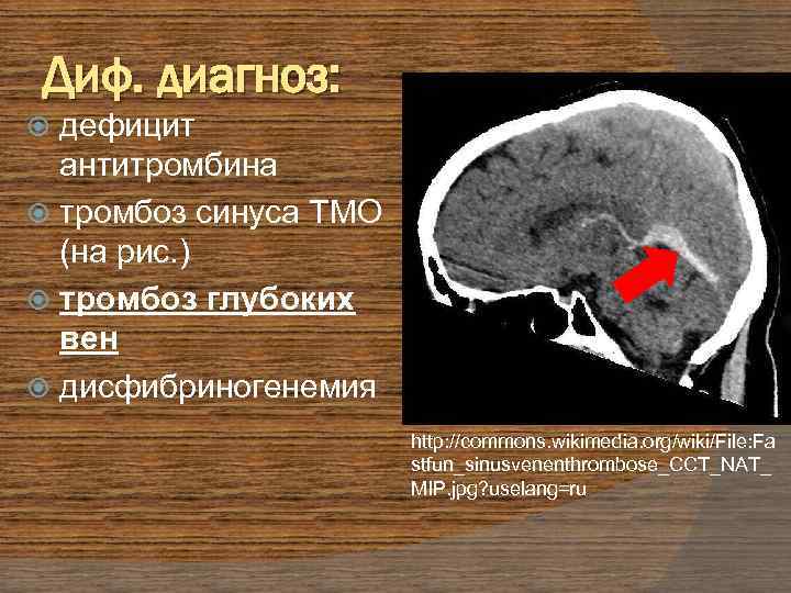 Диф. диагноз: дефицит антитромбина тромбоз синуса ТМО (на рис. ) тромбоз глубоких вен дисфибриногенемия