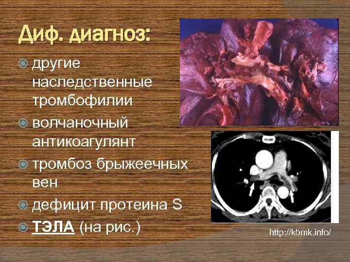 Диф. диагноз: другие наследственные тромбофилии волчаночный антикоагулянт тромбоз брыжеечных вен дефицит протеина S ТЭЛА