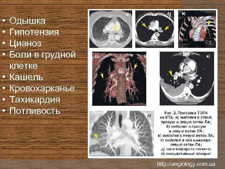  • • Одышка Гипотензия Цианоз Боли в грудной клетке Кашель Кровохарканье Тахикардия Потливость