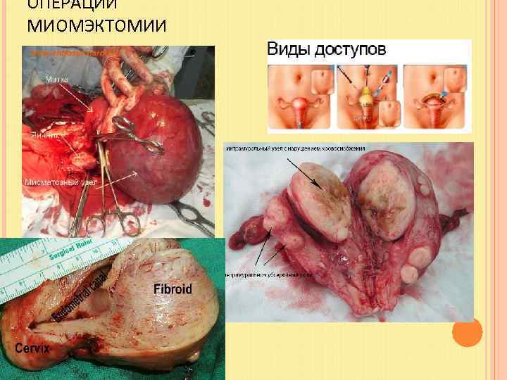 ОПЕРАЦИИ МИОМЭКТОМИИ 