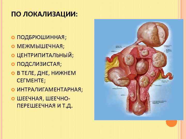 ПО ЛОКАЛИЗАЦИИ: ПОДБРЮШИННАЯ; МЕЖМЫШЕЧНАЯ; ЦЕНТРИПИТАЛЬНЫЙ; ПОДСЛИЗИСТАЯ; В ТЕЛЕ, ДНЕ, НИЖНЕМ СЕГМЕНТЕ; ИНТРАЛИГАМЕНТАРНАЯ; ШЕЕЧНАЯ, ШЕЕЧНОПЕРЕШЕЕЧНАЯ