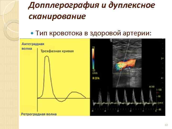 Допплерография и дуплексное сканирование Тип кровотока в здоровой артерии: 12 