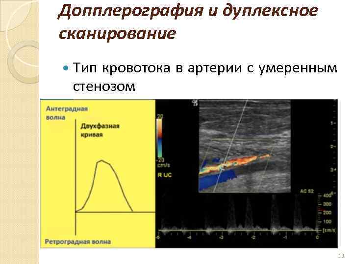 Допплерография и дуплексное сканирование Тип кровотока в артерии с умеренным стенозом 13 