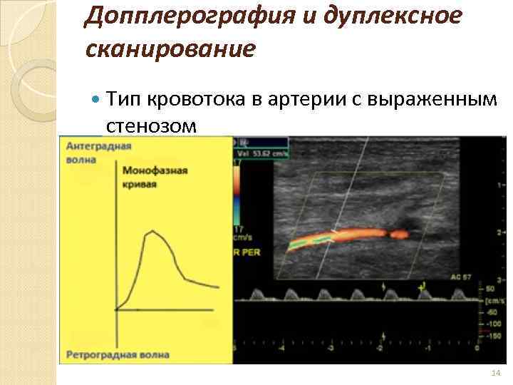 Допплерография и дуплексное сканирование Тип кровотока в артерии с выраженным стенозом 14 