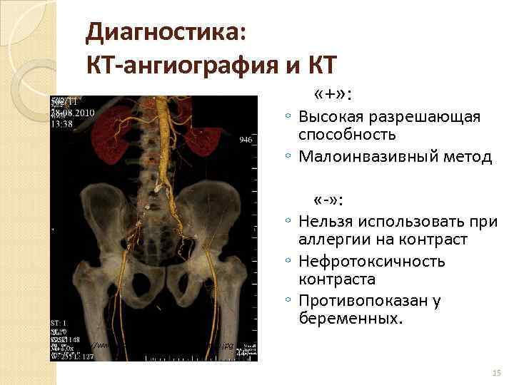 Диагностика: КТ-ангиография и КТ «+» : ◦ Высокая разрешающая способность ◦ Малоинвазивный метод «-»