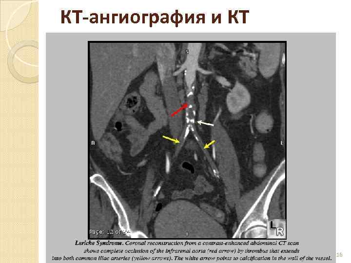 КТ-ангиография и КТ 16 