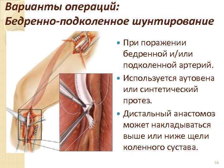 Варианты операций: Бедренно-подколенное шунтирование При поражении бедренной и/или подколенной артерий. Используется аутовена или синтетический