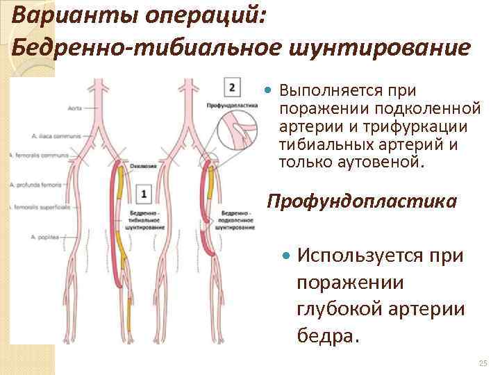 Артерия ноги операция. Бедренно-переднетибиальное шунтирование. Бедренно подколенное шунтирование техника операции этапы. Бедренно-подколенное шунтирование схема. Аорто бедренная и подколенная шунтирование.