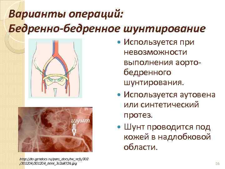 Варианты операций: Бедренно-бедренное шунтирование Используется при невозможности выполнения аортобедренного шунтирования. Используется аутовена или синтетический