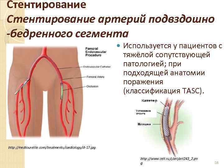 Стентирование артерий подвздошно -бедренного сегмента Используется у пациентов с тяжёлой сопутствующей патологией; при подходящей