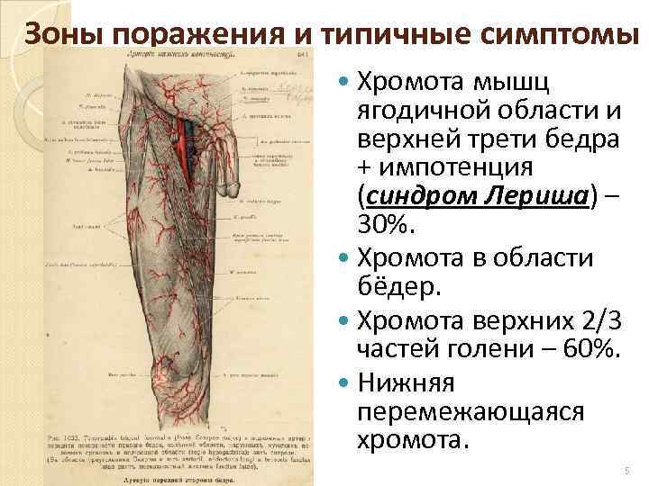 Зоны поражения и типичные симптомы Хромота мышц ягодичной области и верхней трети бедра +