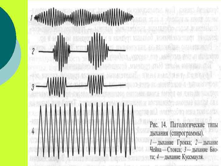 Патология дыхания. Патологические типы дыхания Куссмауля Биота Чейна-Стокса Грокка. Типы периодического патологического дыхания. Патологические типы дыхания Грокка. Диаграмма патологические типы дыхания Куссмауля.