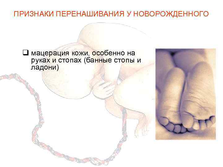 ПРИЗНАКИ ПЕРЕНАШИВАНИЯ У НОВОРОЖДЕННОГО q мацерация кожи, особенно на руках и стопах (банные стопы