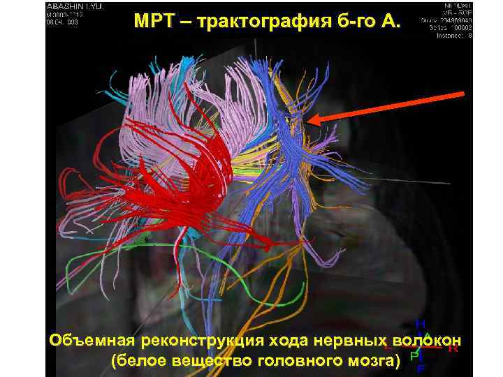 Мрт диффузное тензорное изображение