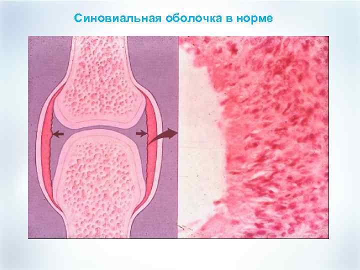 Синовиальная оболочка в норме 
