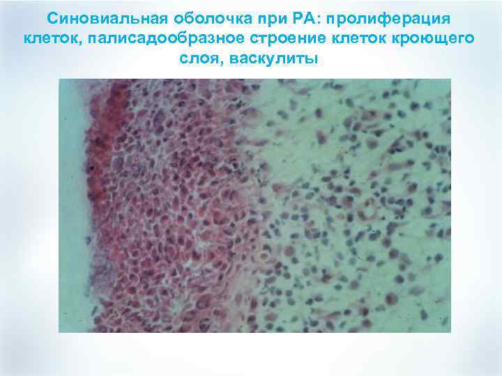 Синовиальная оболочка при РА: пролиферация клеток, палисадообразное строение клеток кроющего слоя, васкулиты 
