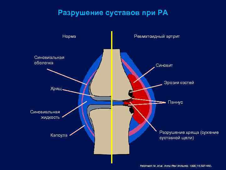 Разрушение суставов при РА Норма Синовиальная оболочка Ревматоидный артрит Синовит Эрозия костей Хрящ Паннус