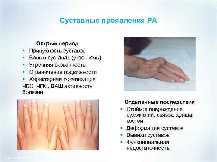 Суставные проявления РА Острый период § Припухлость суставов § Боль в суставах (утро, ночь)