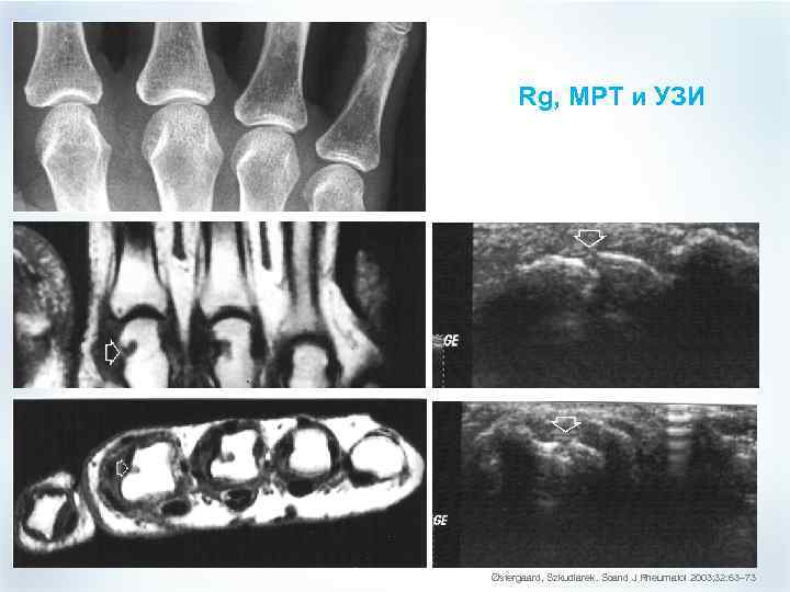 Rg, МРТ и УЗИ Østergaard, Szkudlarek. Scand J Rheumatol 2003; 32: 63– 73 
