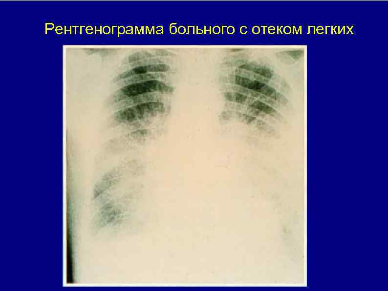 Рентгенограмма больного с отеком легких 