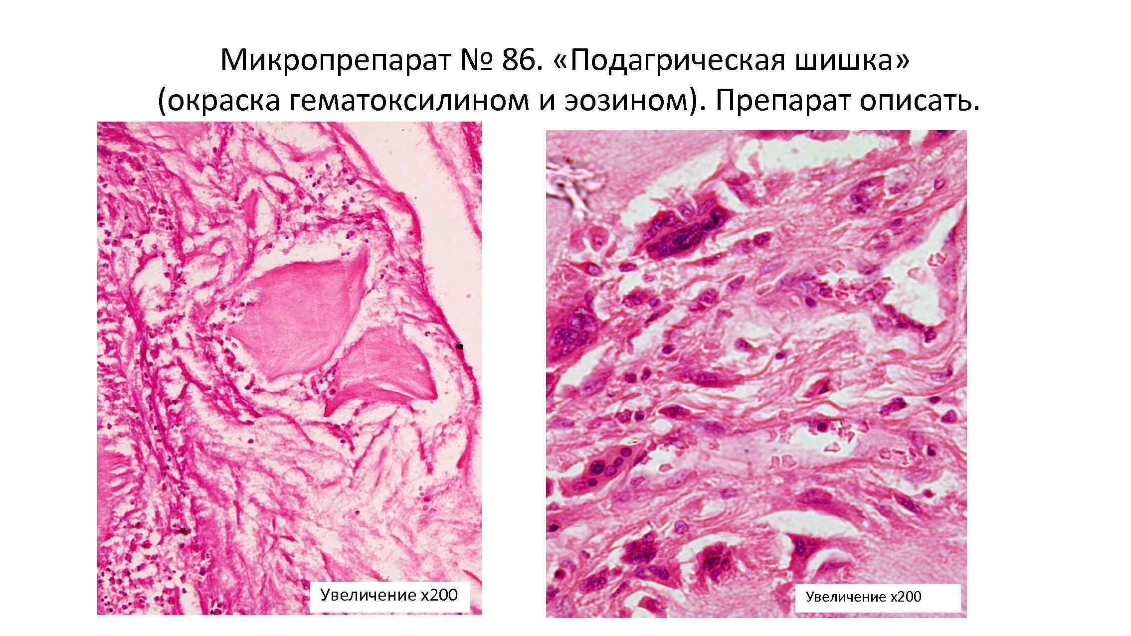 Подагра микропрепарат рисунок описание