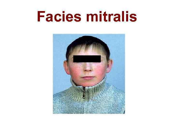 Facies mitralis 