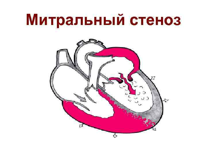 Митральный стеноз 